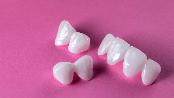 Carillas dentales, qué son y para qué sirven