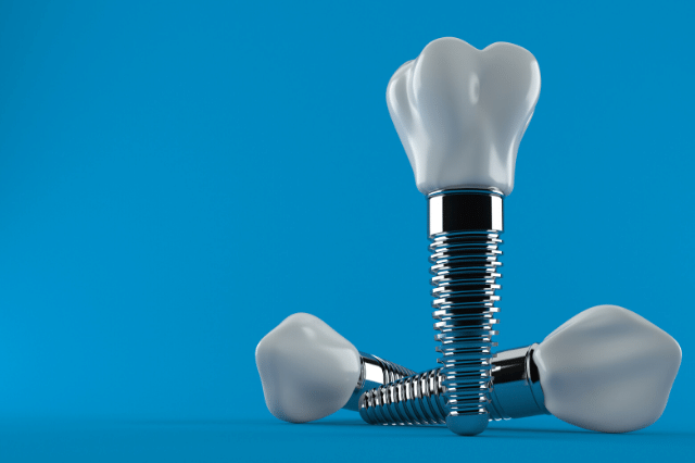 Cómo mantener tus implantes dentales