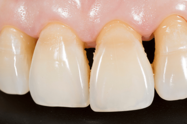 Todo lo que necesitas saber sobre la placa dental